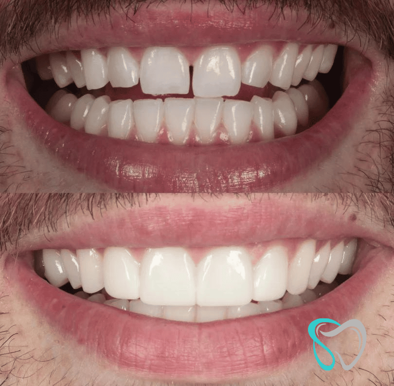 Before After - Smiles By Jasmine