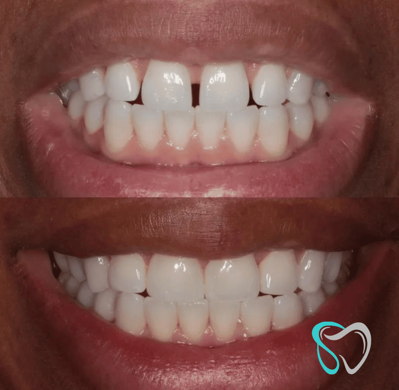 Before - smilesbyjasmine Dental New