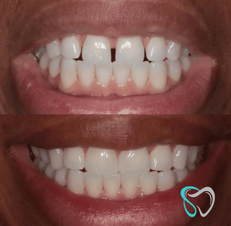 Before After - Smiles By Jasmine