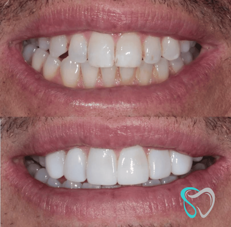 Before After - Smiles By Jasmine