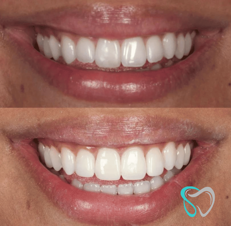 Before After - Smiles By Jasmine