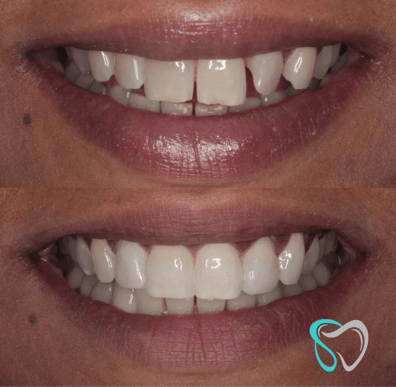 Before After - Smiles By Jasmine