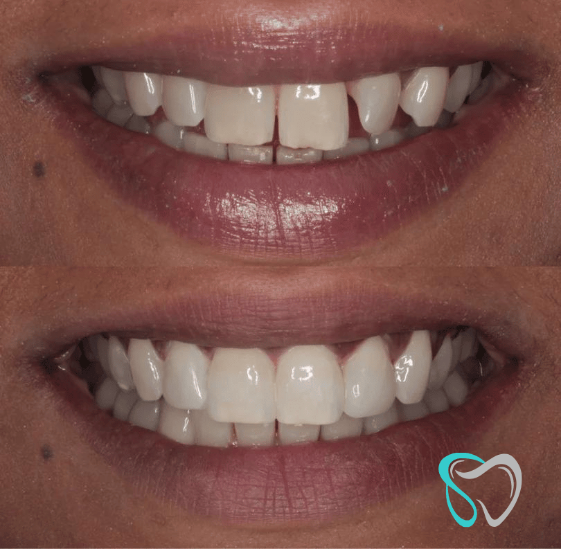 Before - smilesbyjasmine Dental New