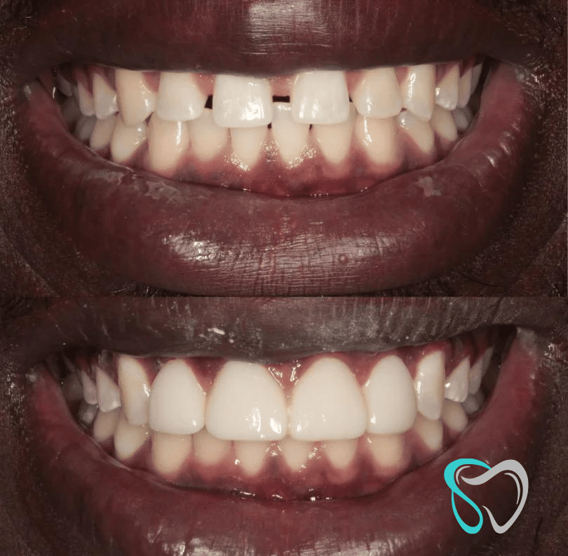 Before - smilesbyjasmine Dental New