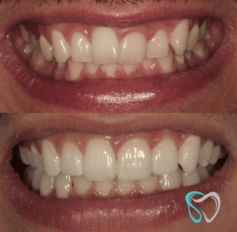 Before - smilesbyjasmine Dental New
