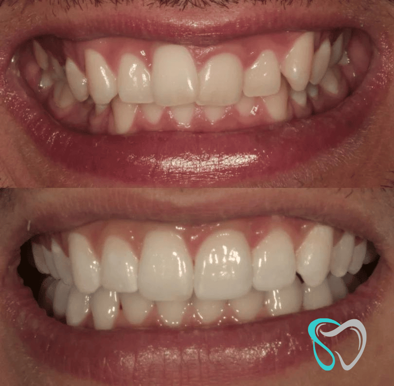 Before After - Smiles By Jasmine