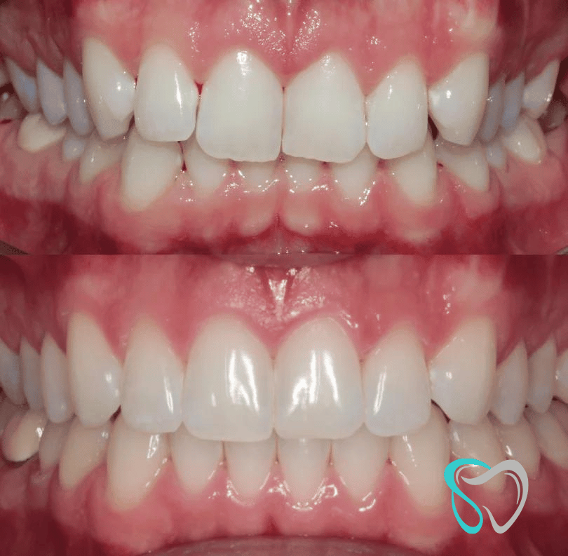 Before - smilesbyjasmine Dental New