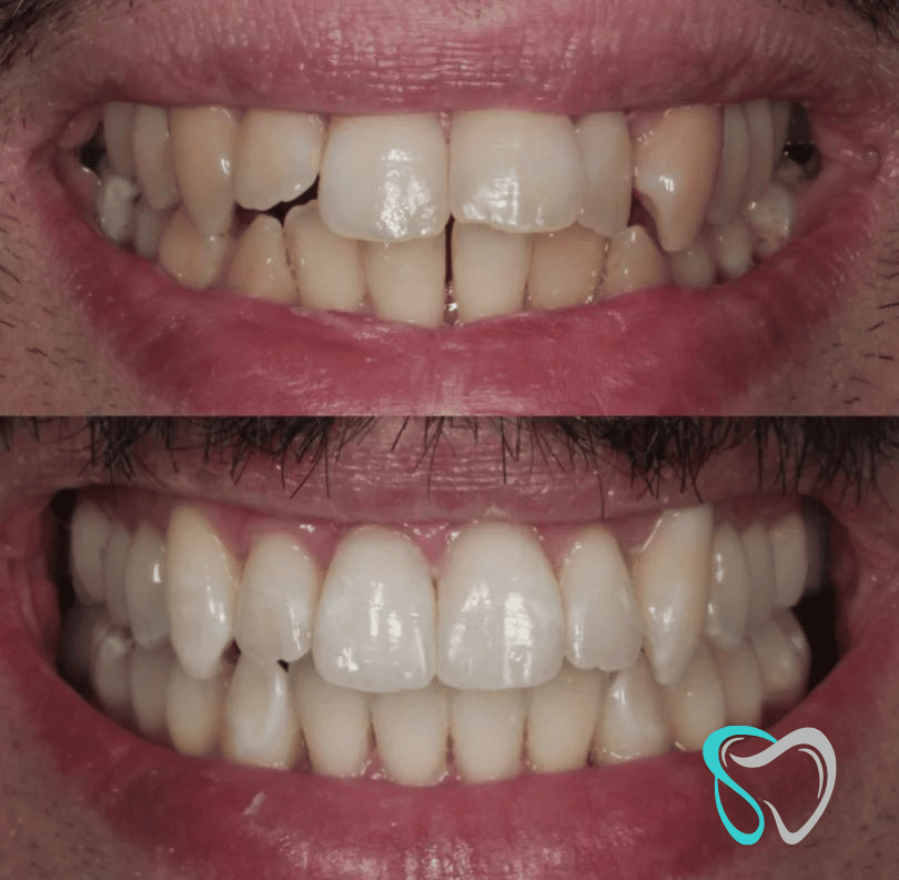 Before After - Smiles By Jasmine