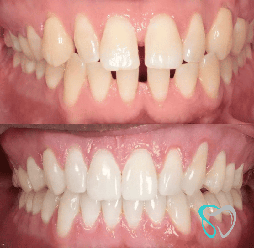 Before - smilesbyjasmine Dental New