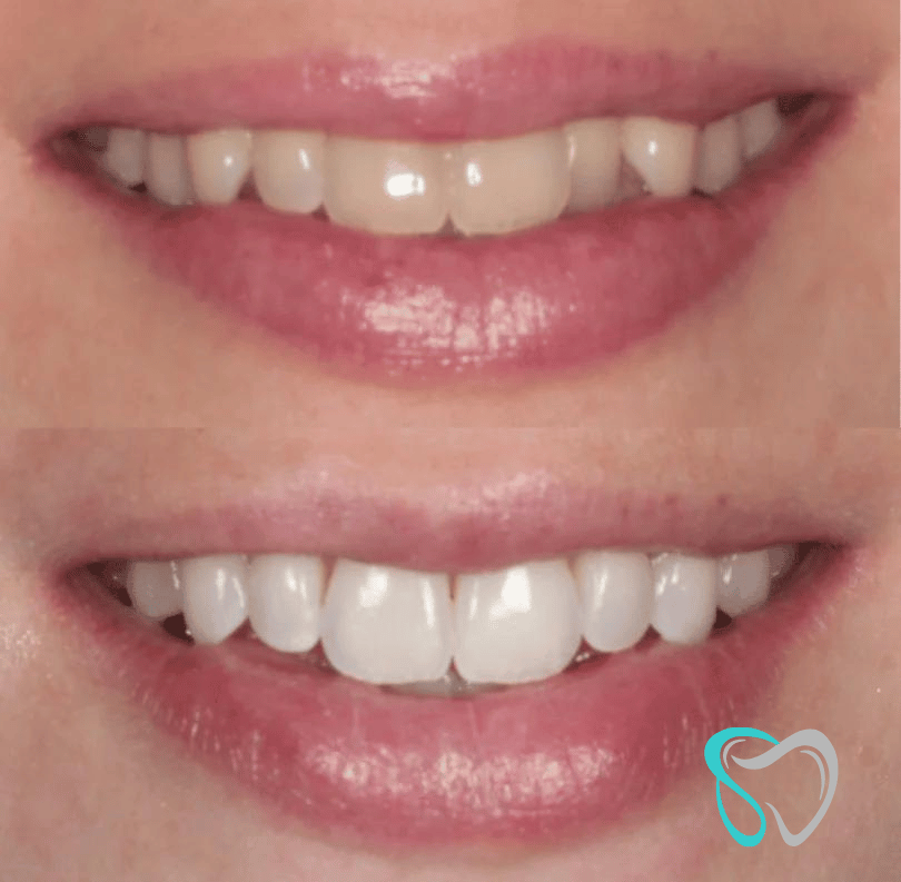 Before - smilesbyjasmine Dental New