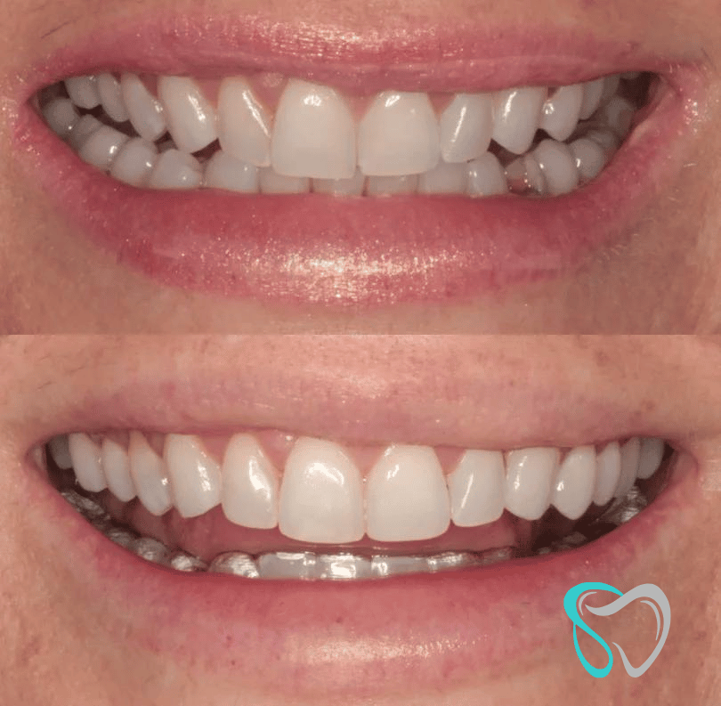 Before After - Smiles By Jasmine