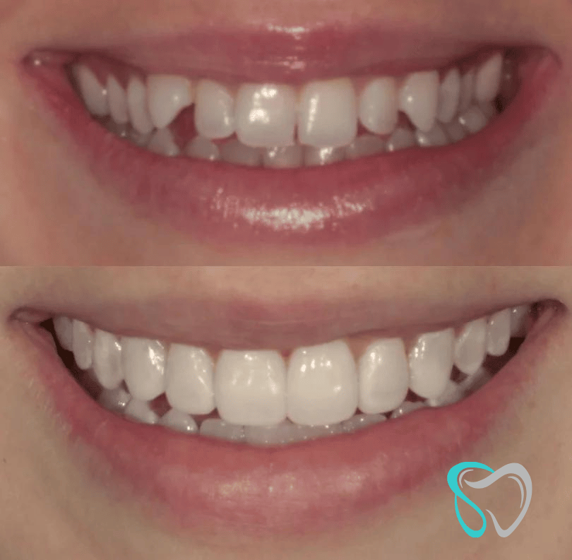 Before - smilesbyjasmine Dental New