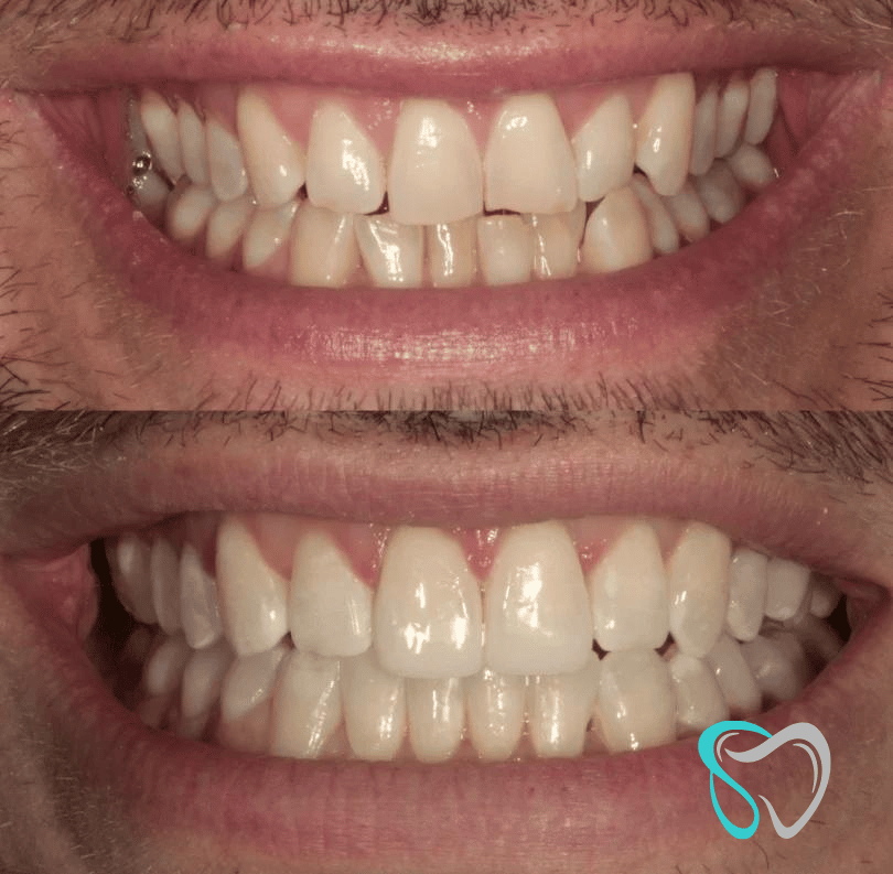 Before - smilesbyjasmine Dental New