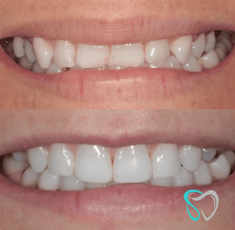 Before - smilesbyjasmine Dental New