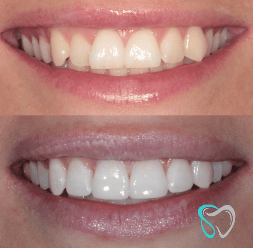 Before - smilesbyjasmine Dental New