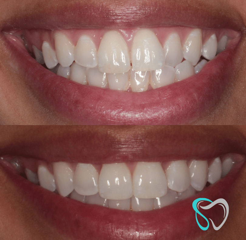 Before - smilesbyjasmine Dental New