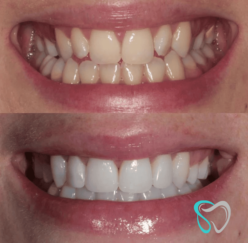 Before After - Smiles By Jasmine