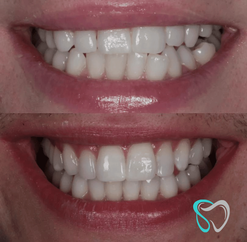 Before - smilesbyjasmine Dental New