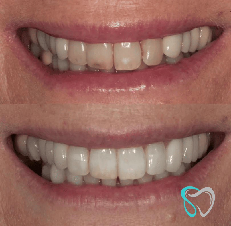 Before - smilesbyjasmine Dental New