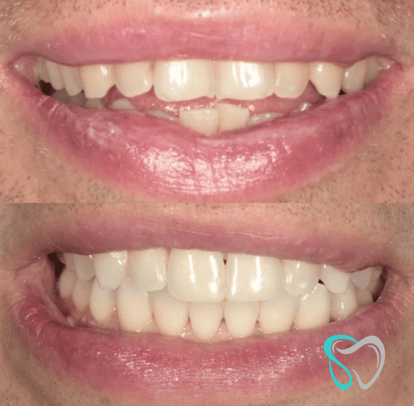 Before After - Smiles By Jasmine