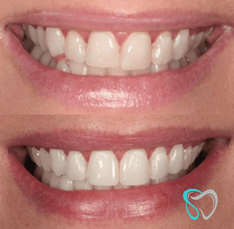 Before - smilesbyjasmine Dental New