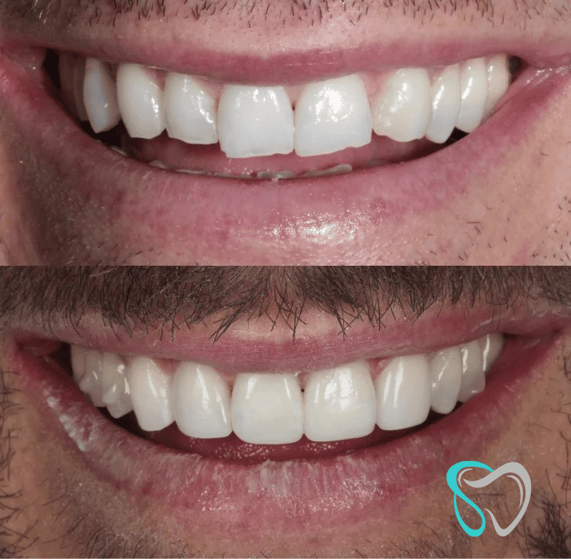 Before - smilesbyjasmine Dental New