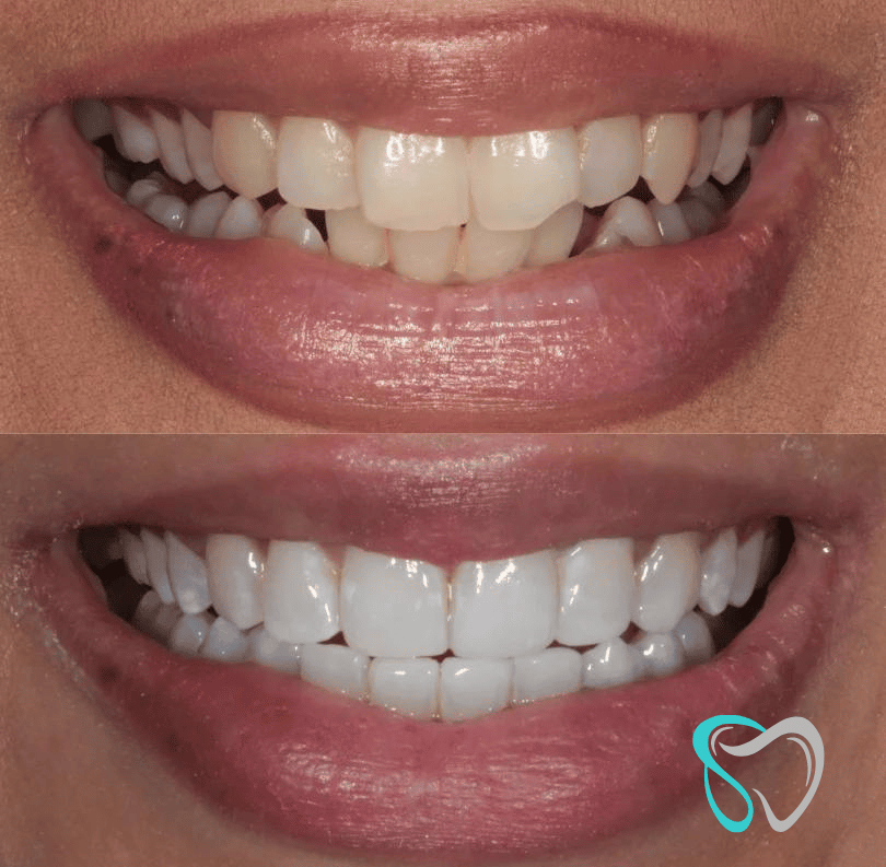 Before After - Smiles By Jasmine