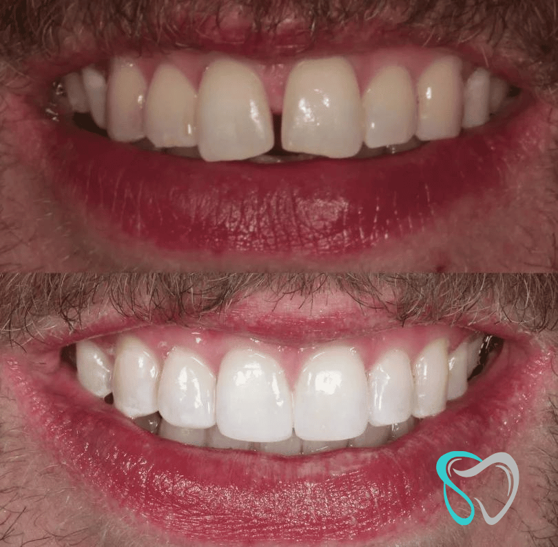 Before - smilesbyjasmine Dental New