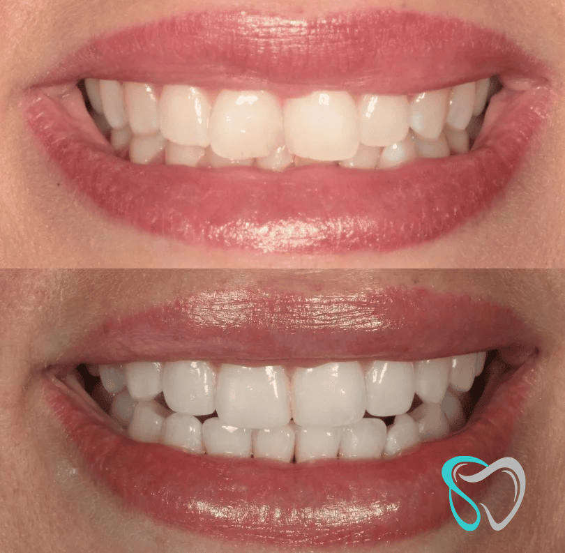 Before After - Smiles By Jasmine