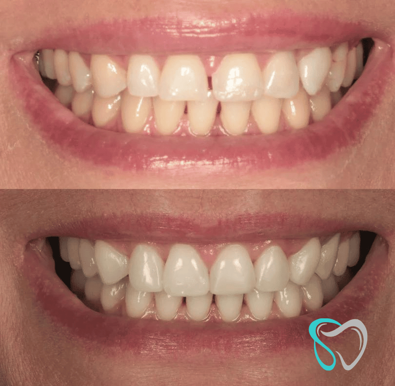 Before - smilesbyjasmine Dental New