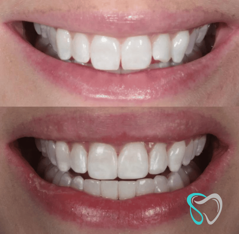 Before After - Smiles By Jasmine