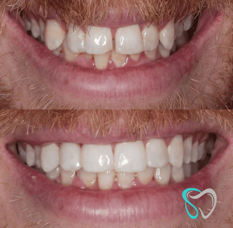 Before - smilesbyjasmine Dental New