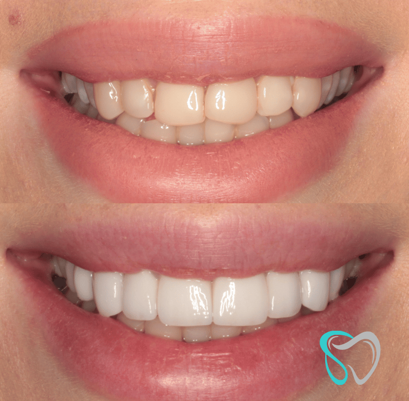 Before - smilesbyjasmine Dental New