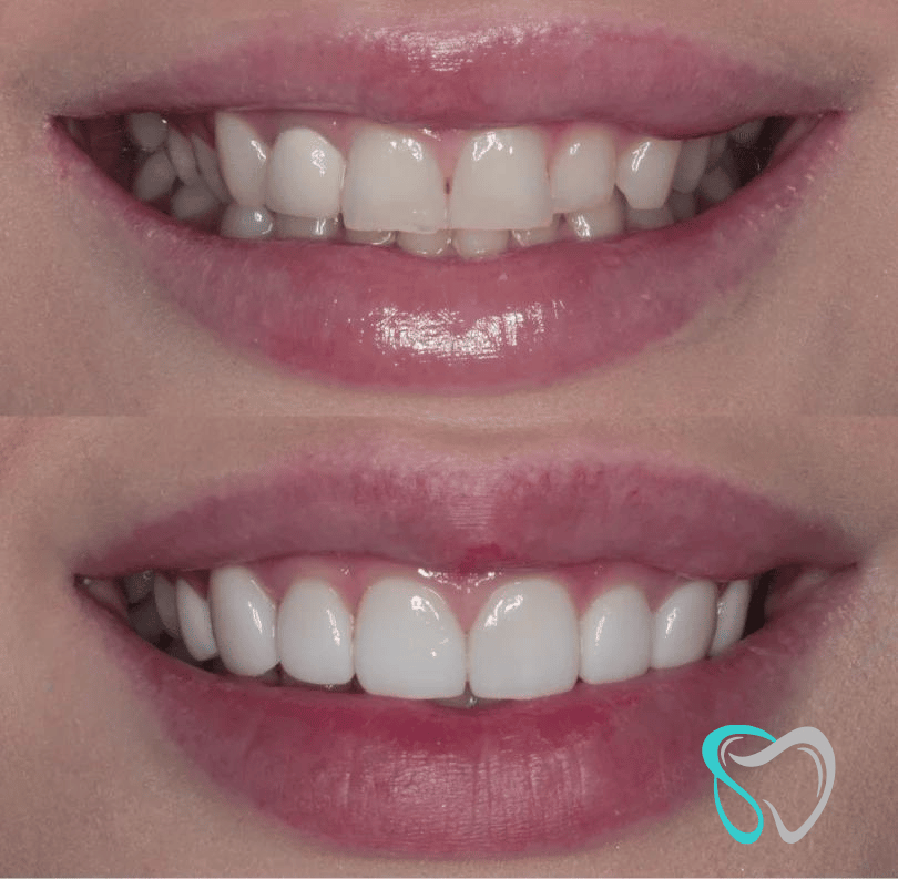 Before After - Smiles By Jasmine