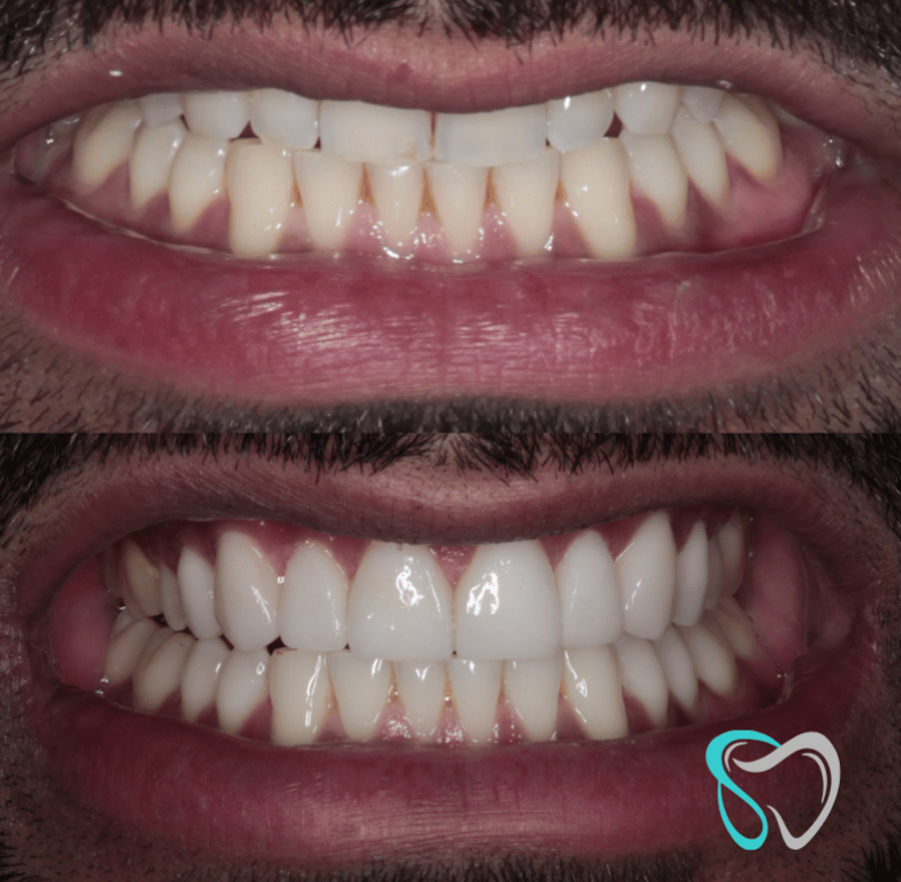 Before - smilesbyjasmine Dental New