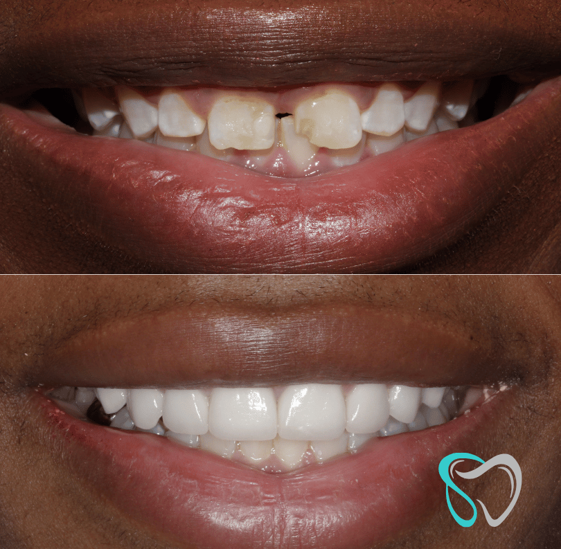 Before - smilesbyjasmine Dental New