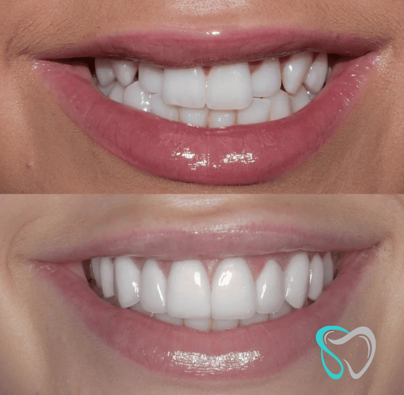 Before After - Smiles By Jasmine