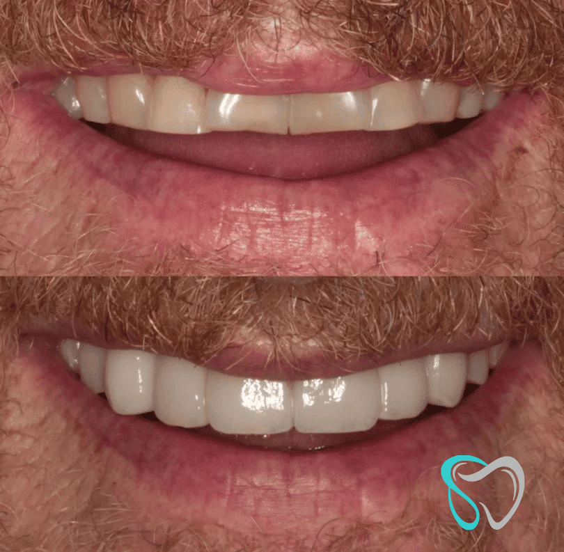 Before - smilesbyjasmine Dental New