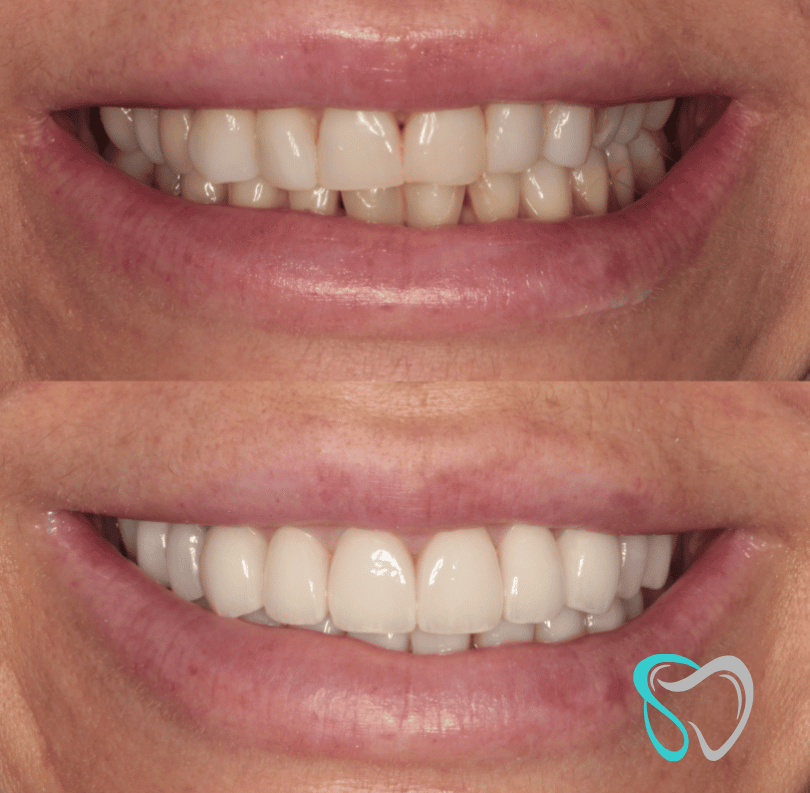 Before - smilesbyjasmine Dental New